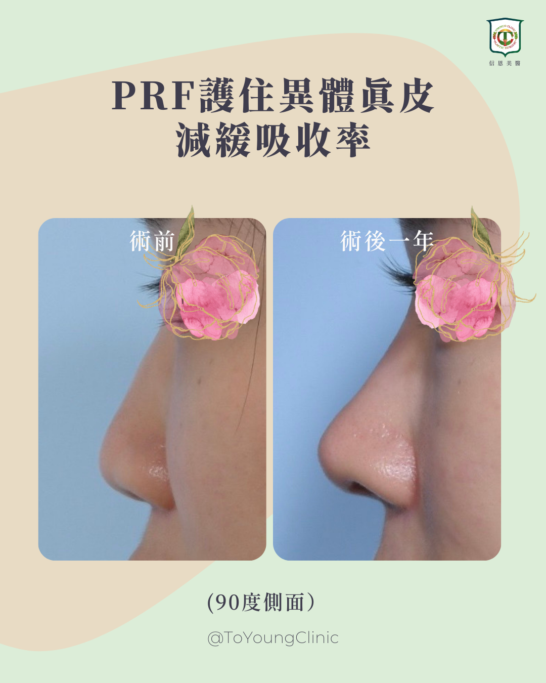 異體真皮隆鼻容易被吸收？破解迷思，PRF 技術讓美麗更持久！